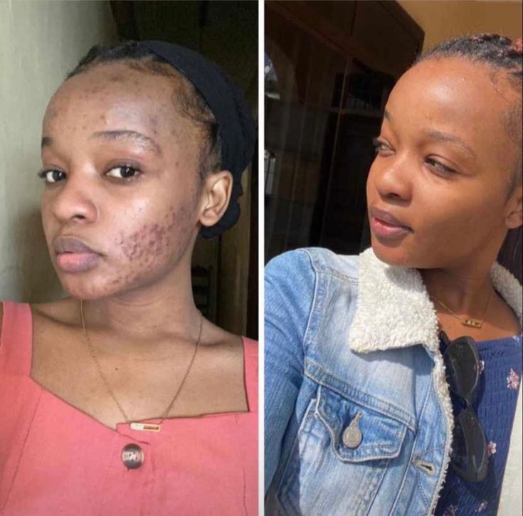 😍Creme Milagroso da coconut 🥥 😍 Pele Lisa em Apenas 7 dias🔥